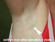 plastic-surgery-breast-augmentation 